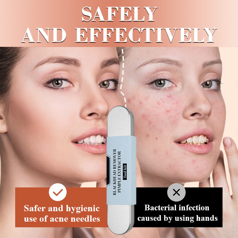 🎈 2026 Sale — Over 37,000 Sold! 🧴 Medical Grade Blackhead Extraction Tool Kit